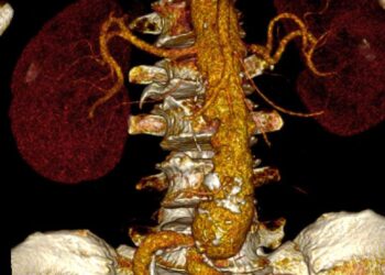 Histórica cirugía aórtica posiciona al ISSSTE de Mérida como referente médico